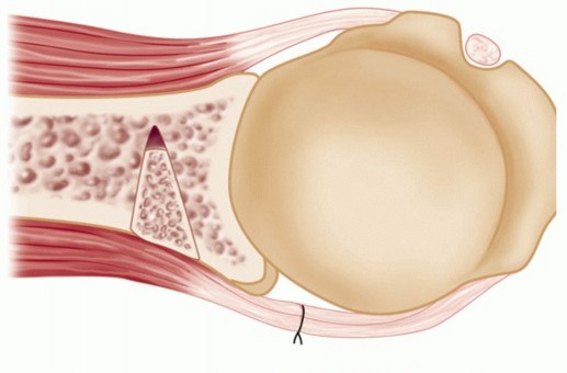 Illustration 33 for Finally Treat Recurrent Posterior Instability of the Shoulder