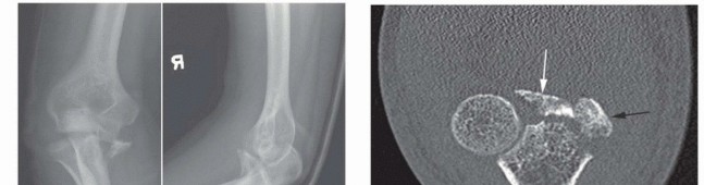 Illustration 4 for Restore Stability & Motion: Fixation of Fracture-Dislocations