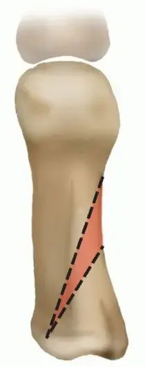 صورة توضيحية لـ جراحة قطع العظم الإسفيني القريب (الوكعة): حل دائم لآلام إبهام القدم الأروح في اليمن والخليج العربي مع الأستاذ الدكتور محمد هطيف