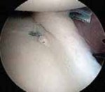 Illustration 29 for Regain Stability: Anterior Shoulder Instability Arthroscopic Fix