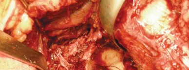 Illustration 44 for Navigating Early THA for Fractures of the Acetabulum