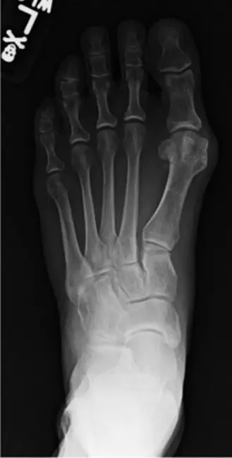 صورة توضيحية لـ إبهام القدم الأروح (الوكعة): دليل شامل للعلاج الجراحي وتحرير الأنسجة الرخوة مع الأستاذ الدكتور محمد هطيف في صنعاء