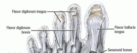 Restore Your Foot: Surgical Treatment for Hallux MP Joint Turf Toe