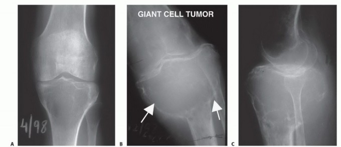 Illustration 3 for Tackling Complex Tumors of the Proximal Tibia: Limb-Sparing Solutions