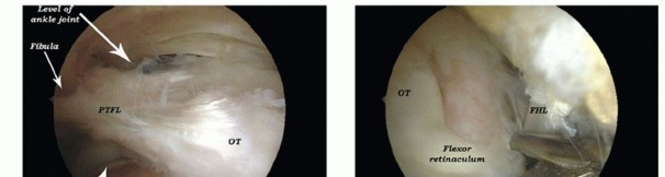 Illustration 17 for Posterior Talar Process: Endoscopic Solutions for Ankle Pain