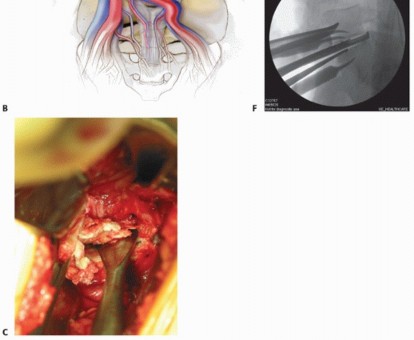 Illustration 9 for Anterior Lumbar Interbody: Fusion, Disc Replacement & Pain Relief