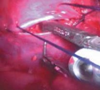 Illustration 30 for Mastering Anterior Interbody Arthrodesis with Instrumentation for Scoliosis