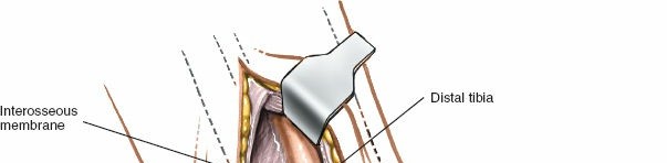 Illustration 94 for Optimized Approaches to the Dorsum of the Foot & Ankle
