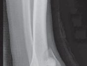 Illustration 16 for Optimizing ORIF for Tibial Plafond Fractures: A Modern Approach