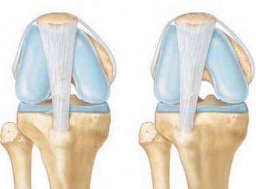 Illustration of patella enters the trochlea - Dr. Mohammed Hutaif