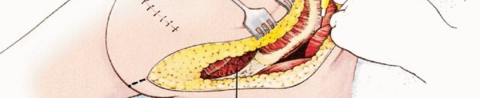 Illustration 13 for Anterior Flap Hemipelvectomy: Leveraging fig tech fig for Difficult Tumors