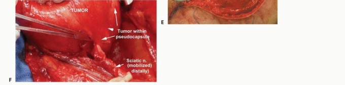 Illustration 14 for Posterior Thigh Resection: Rethinking Outcomes & Limb Sparing