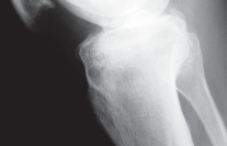 صورة توضيحية لـ جراحة استبدال مفصل الركبة الجزئي (UKA): تجنب الأخطاء والاستفادة القصوى في صنعاء مع الأستاذ الدكتور محمد هطيف