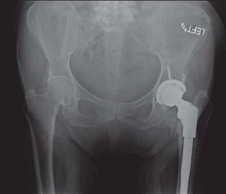 Illustration 28 for Effective Arthroplasty for Salvage of Failed Hip Fixation