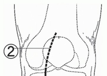 Illustration 5 for High Tibial Osteotomy: Realignment for Lasting Knee Pain Relief