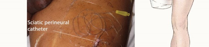 Illustration 24 for Mastering Above-Knee Amputation: Essential Surgical Insights