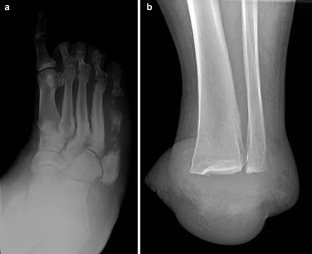 Illustration 125 for First Metatarsal Surgery: Expert Solutions for Foot & Ankle Pain