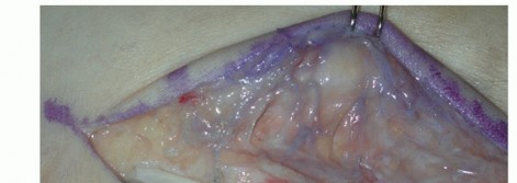 Illustration 39 for Beyond Primary Repair: Solutions for Peroneal Tendon Subluxation