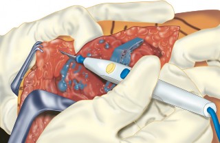 Illustration 39 for Mastering Gap Balancing in Revision TKA: Avoid Common Pitfalls