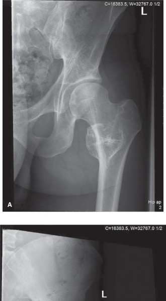 Illustration of oncology cases chondrosarcoma - Dr. Mohammed Hutaif