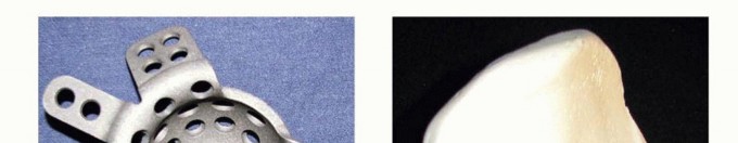 Illustration 7 for Pelvic Discontinuity: Understanding Superior and Inferior Separation