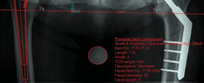 Illustration 2 for Cemented Femoral Stem Figures: Surgical Anatomy & Placement