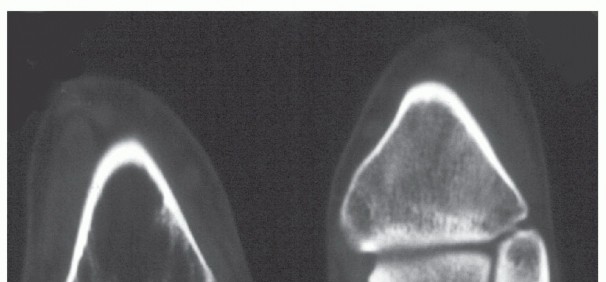 Illustration 3 for Beyond Amputation: Circular Fixation for Infection of the Talus