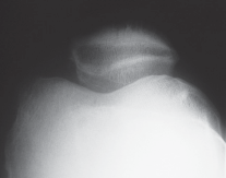 صورة توضيحية لـ جراحة استبدال مفصل الركبة الجزئي (UKA): تجنب الأخطاء والاستفادة القصوى في صنعاء مع الأستاذ الدكتور محمد هطيف