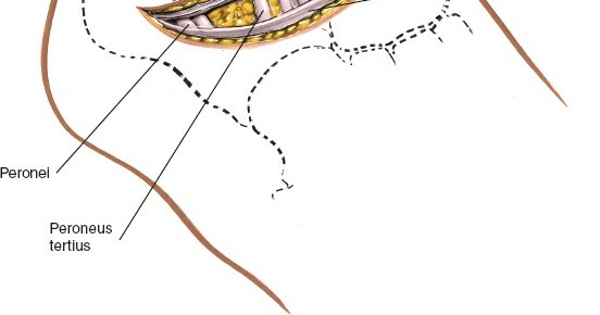 Illustration 106 for Optimized Approaches to the Dorsum of the Foot & Ankle