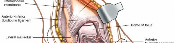 Illustration 99 for Optimized Approaches to the Dorsum of the Foot & Ankle