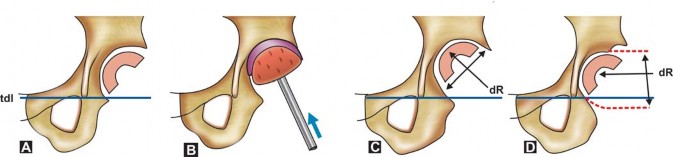 Illustration 7 for Optimizing Acetabular Component Cementation for Superior Outcomes
