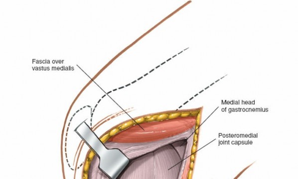 Illustration 73 for Mastering Knee Approaches: Spotlight on Superficial Medial Ligament