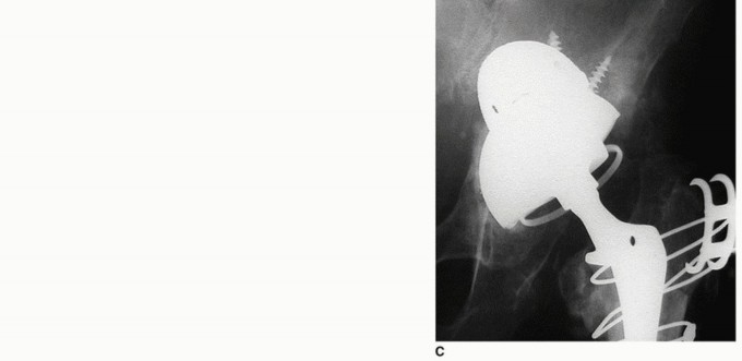 Illustration 8 for Uncemented Acetabular Component: Augments & Cup-Cages for Bone Loss