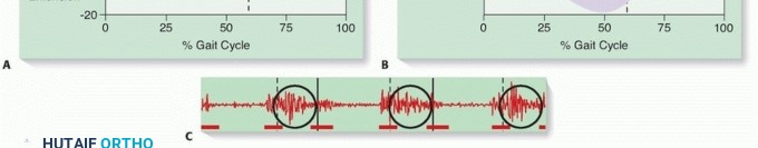 Illustration 4 for Rectus Femoris Muscle Transfer: Restore Gait & Function