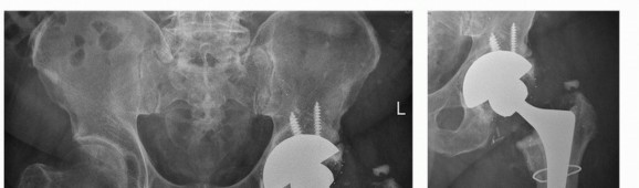 Illustration 56 for Cement in Cement Revision: Simplifying Complex Hip Revisions