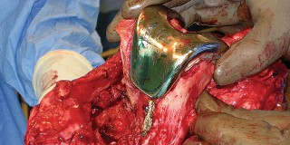 Illustration 37 for Hinged Total Knee: The Salvage Solution for Challenging Cases