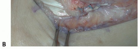 Illustration 40 for Beyond Primary Repair: Solutions for Peroneal Tendon Subluxation