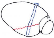 Illustration 10 for Tibial Fracture Extending into the Plafond: Intramedullary Secrets