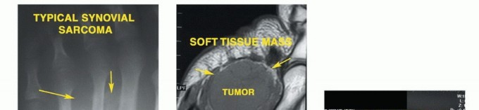 Illustration 4 for Treating Tumors of the Foot: Optimizing Amputation & Resection