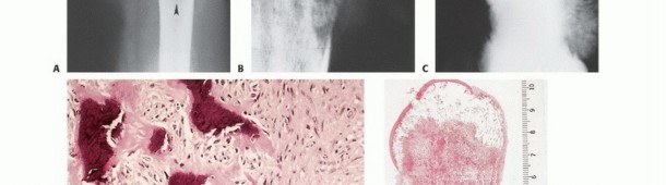 Illustration 35 for Understanding Benign Bone Tumors: Your Complete Preoperative Guide
