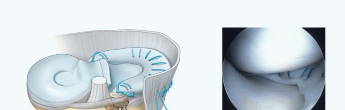 Illustration 30 for Symptomatic Knee? Meniscal Transplant for Anterior & Posterior Horns