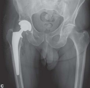 Illustration 7 for Optimal Arthroplasty in Proximal Fractures: What You Need to Know