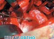 Illustration 22 for FAI: Impingement and Surgical Dislocation Explained