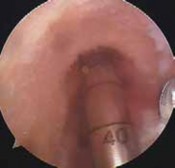 Illustration 68 for Optimizing Single-Bundle Anterior Cruciate Ligament Repair