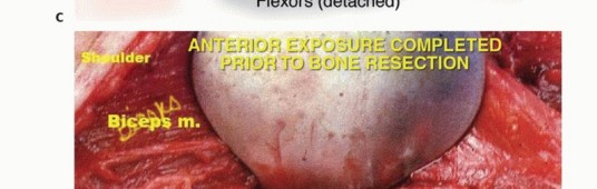 Illustration 13 for Distal Humeral Resection: Safe Techniques for Limb Preservation
