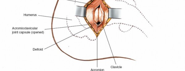Illustration 30 for Deepen Skills: Anterolateral & Lateral Surgical Approaches