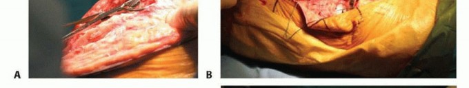 Illustration 6 for Patella Tendon Rupture Reconstruction in Revision TKA