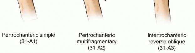 Illustration 4 for ORIF for Peritrochanteric Hip Fractures: Achieve Stable Mobility