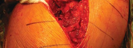 Illustration 41 for Metal on Metal Resurfacing: Enhanced Posterior Soft Tissue Repair