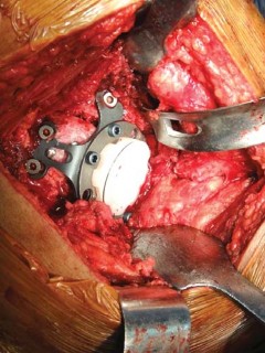 Illustration 39 for Optimizing Arthroplasty in Acute Fractures: Octopus System